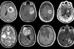 En España se diagnostican más de 5.000 nuevos casos de tumores cerebrales cada año
