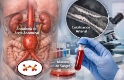 Identifican nuevos factores biol&oacute;gicos implicados en el crecimiento del aneurisma de aorta abdominal