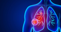 Identificar de forma temprana los síntomas de la neumonía puede evitar complicaciones graves