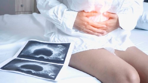 Solo un 25% de los casos de cáncer de ovario se detectan en fases iniciales, según expertos