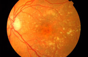 Un implante de retina restaura la visión central en pacientes con DMAE avanzada, según un estudio