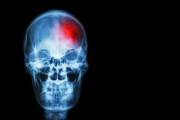 Descubren c&oacute;mo un metabolito de las bacterias intestinales puede influir en el da&ntilde;o cerebral tras un ictus