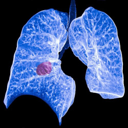 El c&aacute;ncer de pulm&oacute;n precoz hace que las c&eacute;lulas inmunitarias ayuden a los tumores a invadir los pulmones