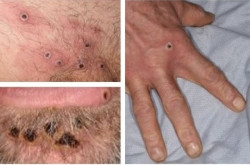 Espa&ntilde;a recibe unos "pocos" tratamientos contra la viruela del mono y llegar&aacute;n "con car&aacute;cter inminente" 200 vacunas