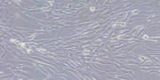 Fibroblastos act&uacute;an como escudo en c&aacute;ncer de v&iacute;as biliares intrahep&aacute;tico para resistir a quimioterapia, seg&uacute;n un estudio