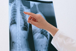 Identifican un biomarcador no invasivo para predecir el beneficio de la inmunoterapia en un tipo de cáncer de pulmón