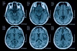 Identifican un compuesto con un efecto neuroprotector "significativo" en traumatismo craneoencefálico