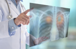 Investigadores alertan de un aumento del cáncer de pulmón en mujeres no fumadoras
