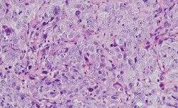 Investigadores del CSIC identifican una proteína implicada en la supervivencia de las pacientes con cáncer de ovario