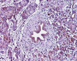 La cirug&iacute;a es un tratamiento viable para los pacientes con c&aacute;ncer de p&aacute;ncreas, especialmente tras la quimioterapia