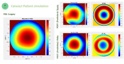 La creación de un ojo virtual del paciente permitirá la toma de decisiones prequirúrgicas personalizadas