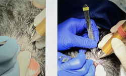 La extracci&oacute;n de unidades foliculares de pelo largo permite realizar el trasplante de pelo sin rasurar el cabello