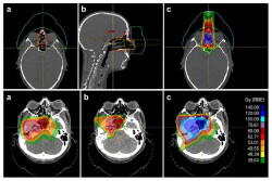 La reirradiaci&oacute;n con protonterapia logra un 67% de supervivencia en c&aacute;ncer de cabeza y cuello, seg&uacute;n un estudio