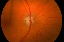 Las c&eacute;lulas cerebrales en forma de estrella pueden jugar un papel fundamental en el glaucoma