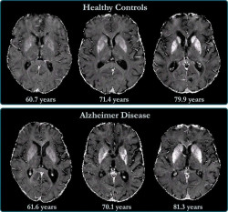 Las neuronas despojadas de su identidad son el sello distintivo de la enfermedad de Alzheimer
