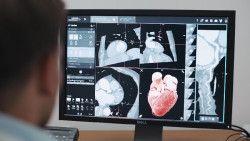 Los avances en el diagn&oacute;stico y tratamiento del ataque card&iacute;aco logran disminuir su tasa de mortalidad