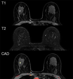 Los modelos de predicci&oacute;n pueden reducir los falsos positivos en el cribado del c&aacute;ncer de mama por resonancia magn&eacute;tica