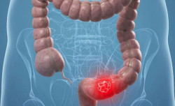 Los retrasos en la detecci&oacute;n del c&aacute;ncer colorrectal debido al COVID causan un aumento del 11,9% en las tasas de