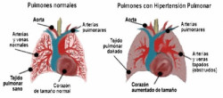M&aacute;s de 3.000 personas en Espa&ntilde;a sufren hipertensi&oacute;n arterial pulmonar, seg&uacute;n expertos