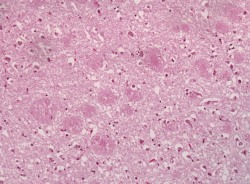 Medicamentos para el Alzheimer reutilizados podr&iacute;an revertir el da&ntilde;o de los vasos sangu&iacute;neos por la diabetes