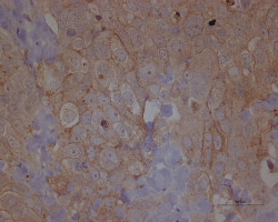 Nuevos hallazgos de enzimas podr&iacute;an abrir la puerta a nuevos tratamientos para frenar la progresi&oacute;n del c&aacute;ncer