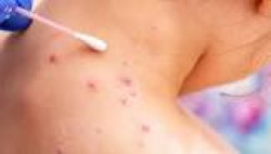 Sanidad registra 67 nuevos casos de viruela del mono en una semana, y ya suman 334 los detectados en 2024