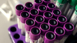 Se detecta la `huella digital` del c&aacute;ncer de pr&oacute;stata en una muestra de sangre