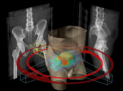 Un estudio internacional intenta determinar cu&aacute;ndo tratar el c&aacute;ncer de pr&oacute;stata y cu&aacute;ndo mantener la vigilancia activa