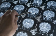 Un estudio se&ntilde;ala que una mol&eacute;cula logra "reprogramar" las defensas del cerebro frente al alzh&eacute;imer