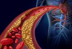 Un experto señala la importancia de reducir el colesterol `malo` frente al riesgo de complicaciones cardiovascular