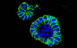 Un fármaco español en investigación potente actividad antitumoral frente a células de cáncer de colon